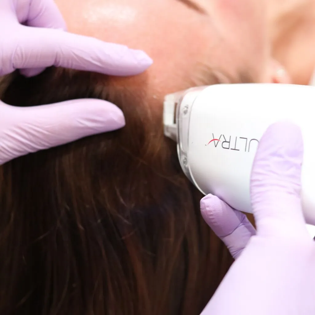 Image of a Keralase hair treatment in progress at Liv Aesthetics LLC in New Fairfield, CT. A technician applies the treatment to a client’s scalp using a handheld device, showcasing a non-invasive procedure aimed at promoting hair growth and scalp health.