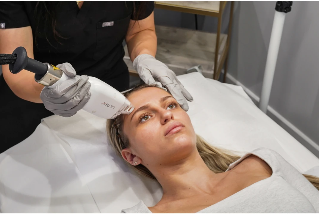 Photo of an Ultra laser treatment at Liv Aesthetics LLC in New Fairfield, CT. A technician uses a precision laser device on a client’s face, demonstrating a non-invasive skin rejuvenation service aimed at improving tone, texture, and overall radiance.